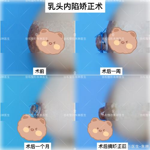 十四岁女孩乳房就特别大正常吗？不用担心，试试[产品名称]，让你健康自信